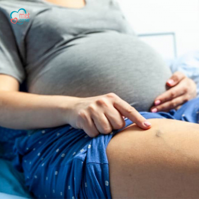 Suy giãn tĩnh mạch khi mang thai ảnh hưởng như thế nào tới mẹ bầu?